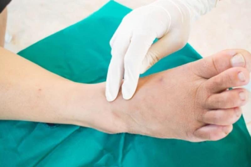 Neuropatía Neuropatía