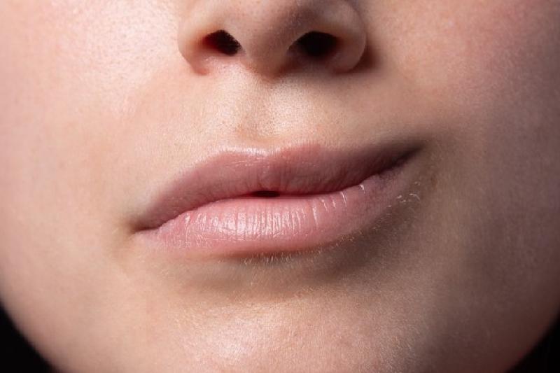 Parálisis-facial Parálisis-facial